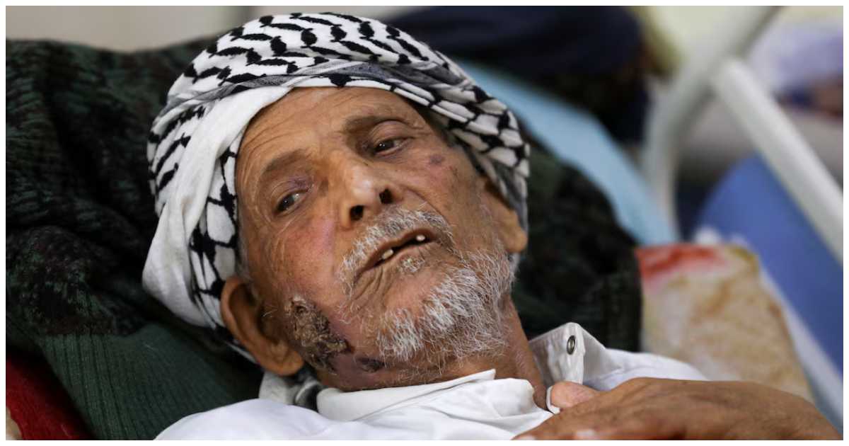 ইয়েমেনের সানায় ২০২২ সালের ২৮ ডিসেম্বর তোলা চিত্রে ন্যাশনাল অনকোলজি সেন্টারে শোয়া ক্যানসার আক্রান্ত রোগী। ছবি: রয়টার্স