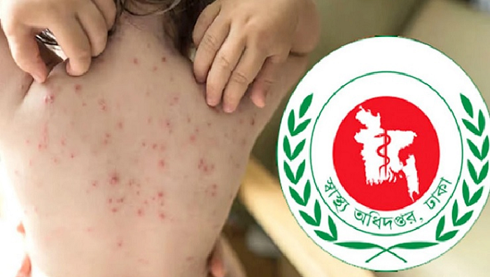 হামের উপসর্গে আরও ৮ মৃত্যু, মোট প্রাণহানি ১১২২